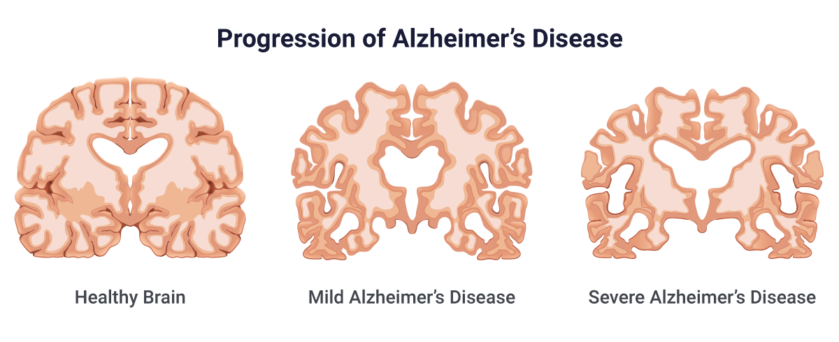 Alzheimers Disease