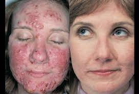  Acne Vulgaris 