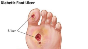Diabetic Foot