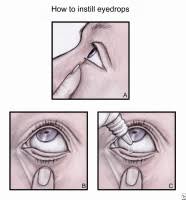 Eye Drops Instillation