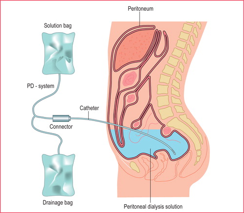Peritoneal Dialysis