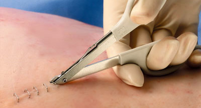 Surgical Staples