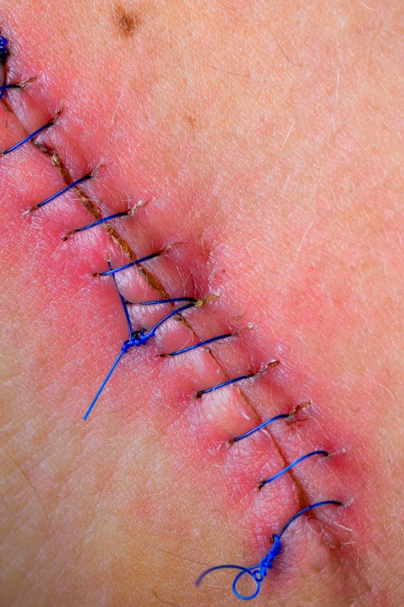 Surgical suture